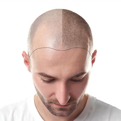 زراعة الشعر في اسطنبول