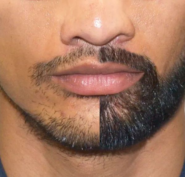 زراعة اللحية في اسطنبول