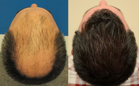 زراعة الشعر في اسطنبول