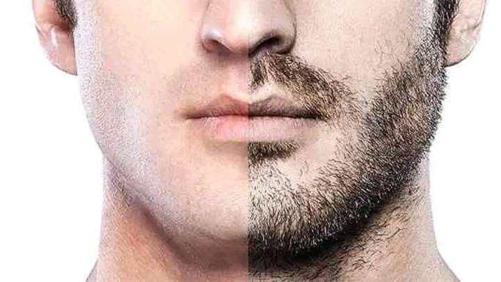 زراعة اللحية اسطنبول