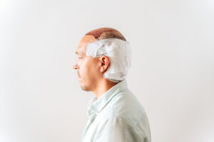 hair transplant procedure