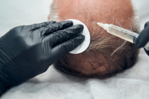 hair transplant success rates