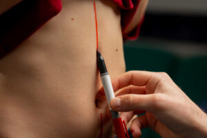 العناية بعد شفط الدهون