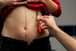 العناية بعد شفط الدهون